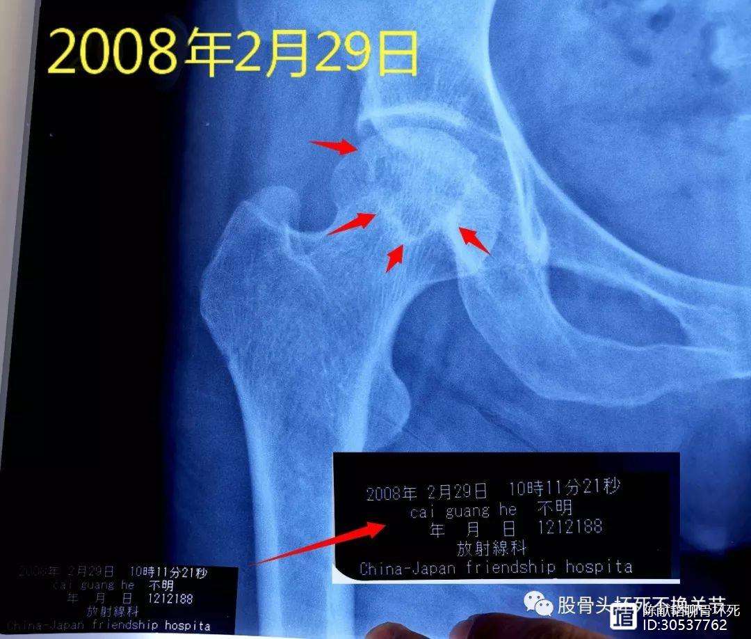 辽宁人工骨头医保报销多少(人工骨头医保报销多少比例)