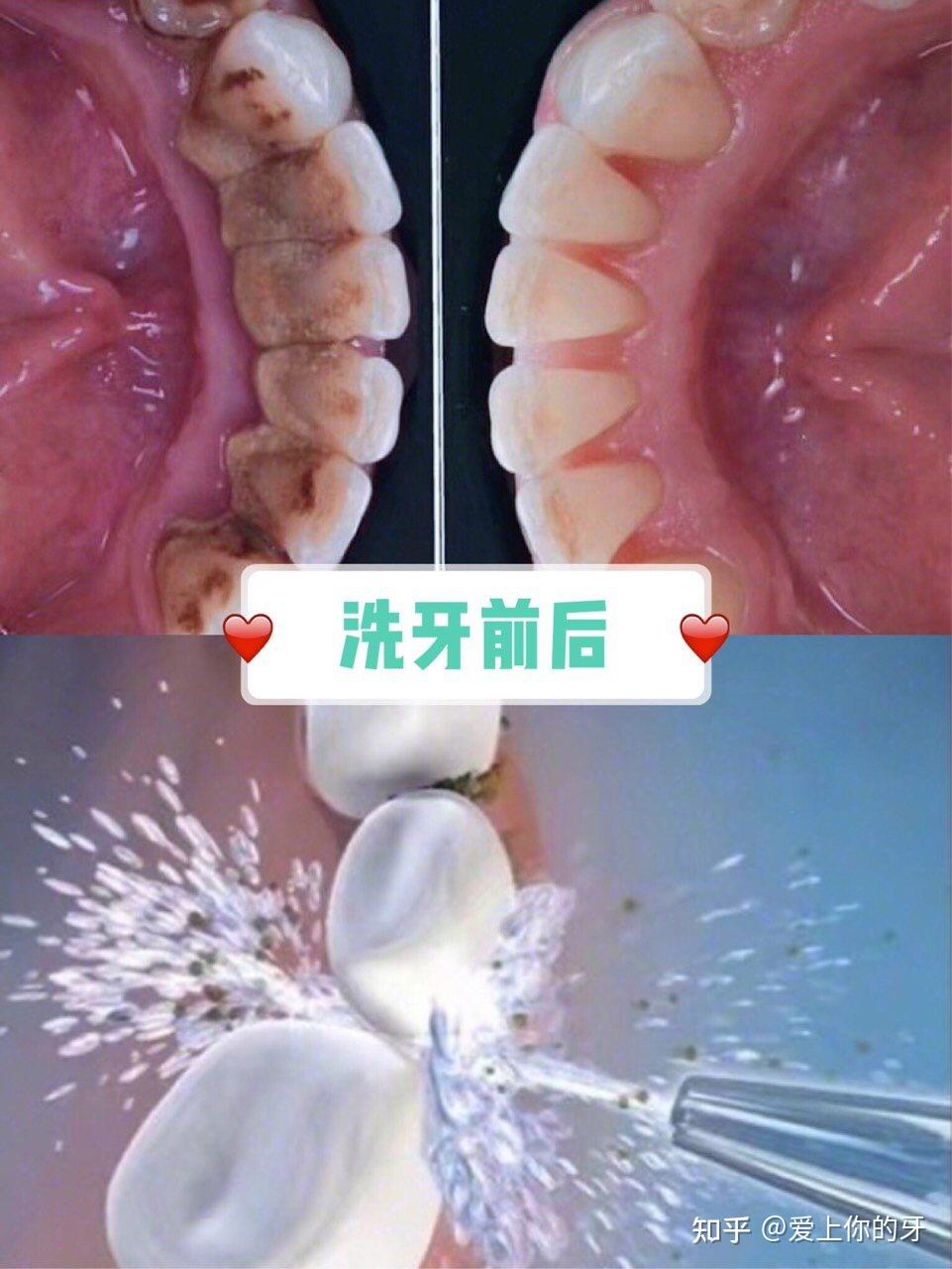 辽宁洗牙可以用医保吗(洗牙可以用医保吗,报销比例多少)